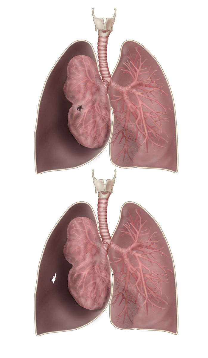 Slagter – Drawing Pneumothorax mechanism - no labels