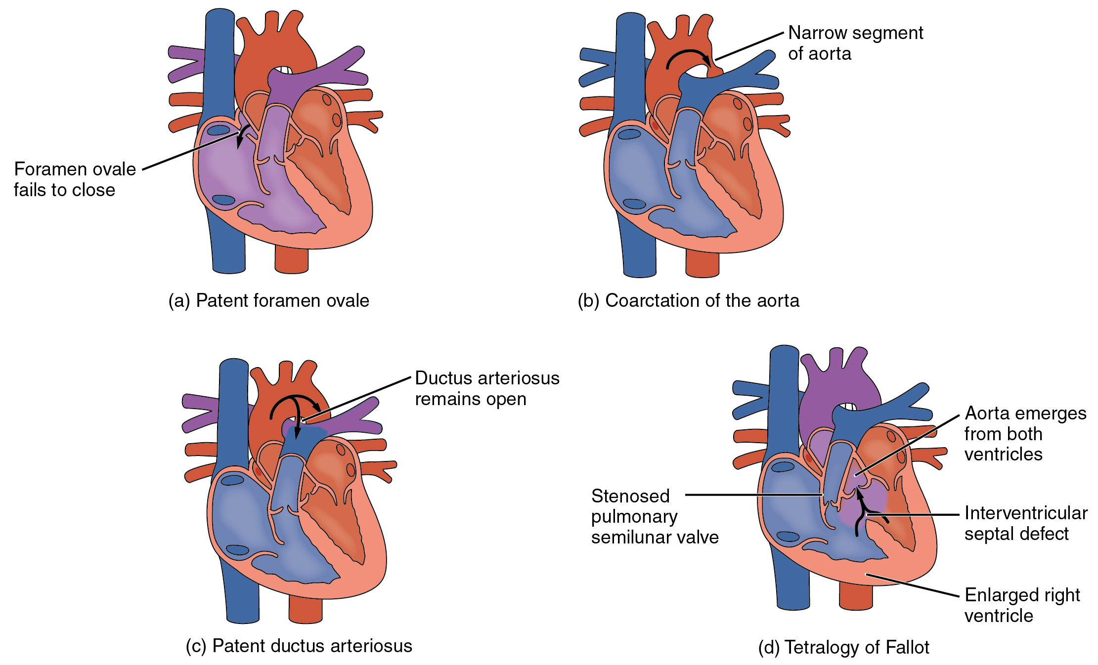 Openstax Anatphys Fig 19 10 Congenital Heart Defects English Labels