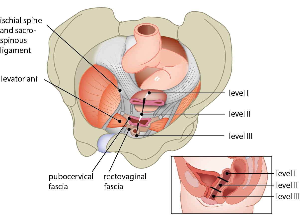 Levels of connective tissue support of female pelvic organs
