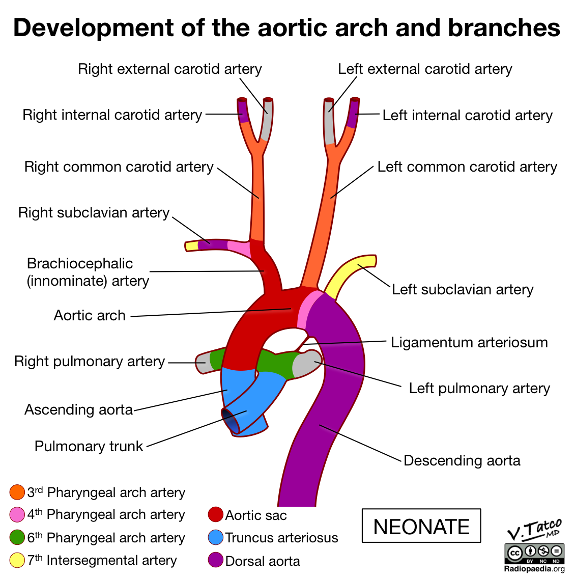 Radiopaedia - Drawing Aortic arch and branches of a neonate - English ...