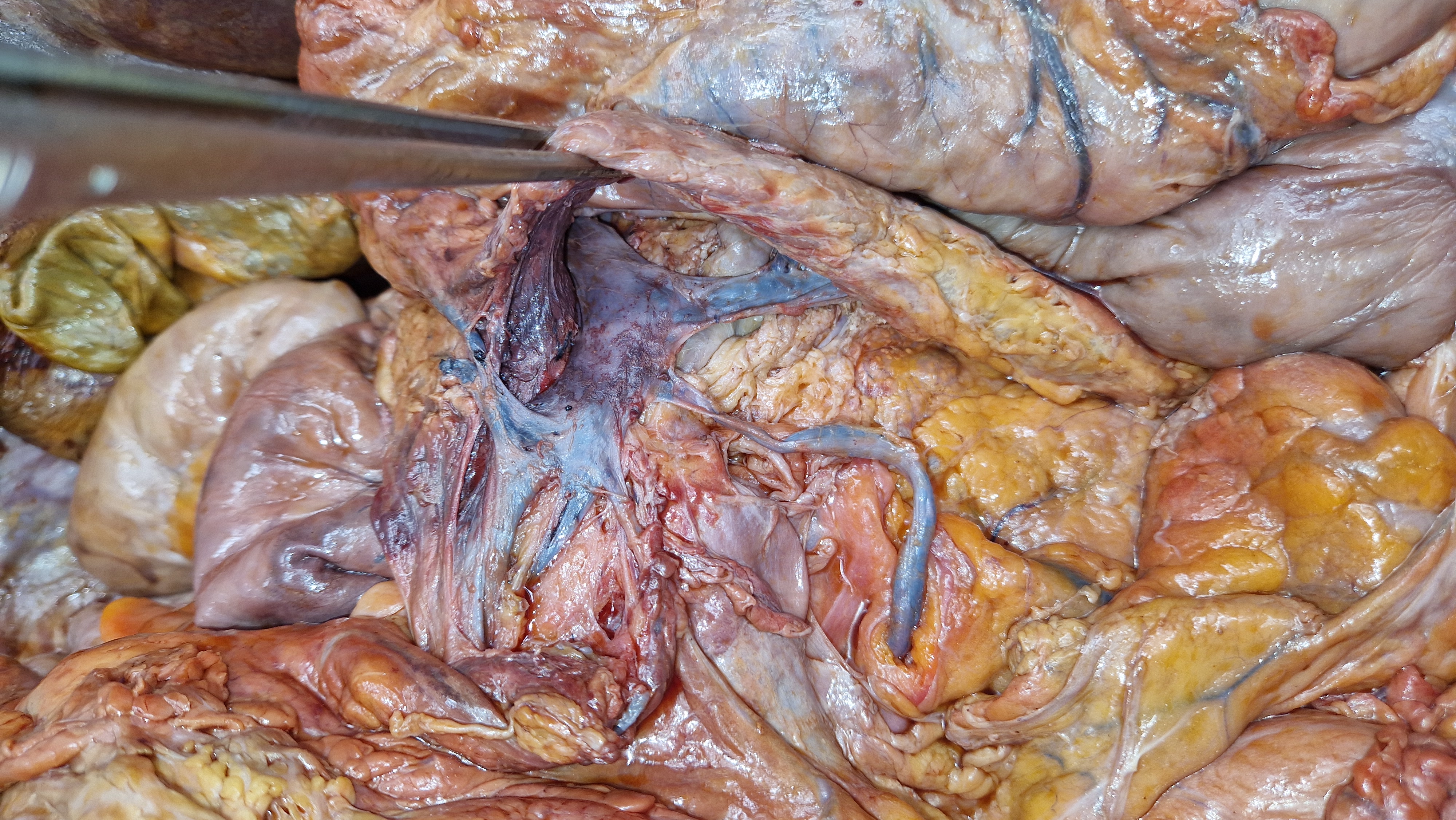 Leiden - Photo Portal vein and contributing veins (dissection) - no labels