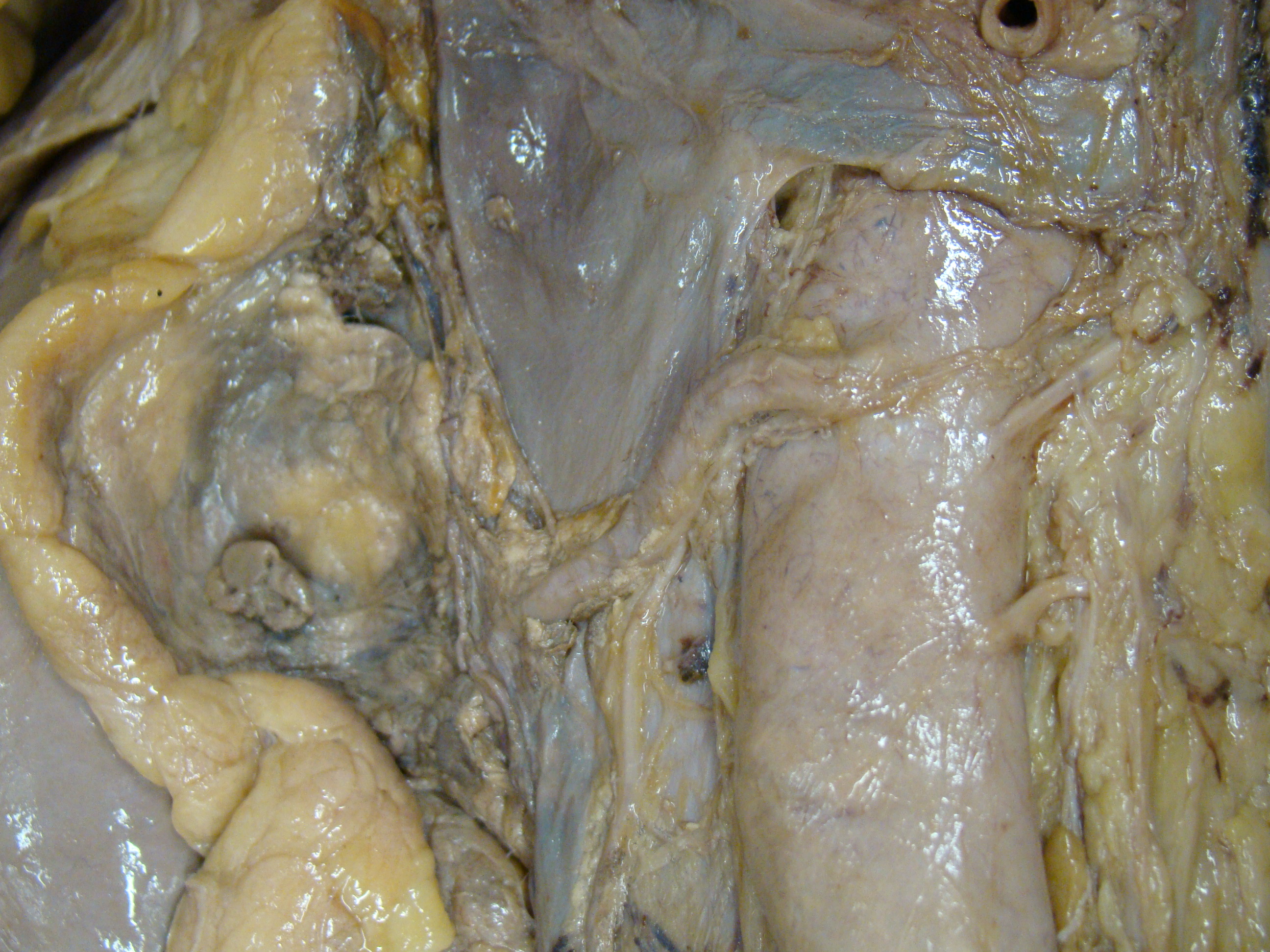 Leiden - Photo Right Aberrant Renal Artery (Dissection) - no labels