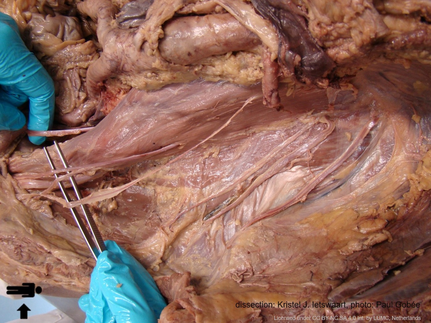 Nerves of posterior abdominal wall, dissection photo - no labels