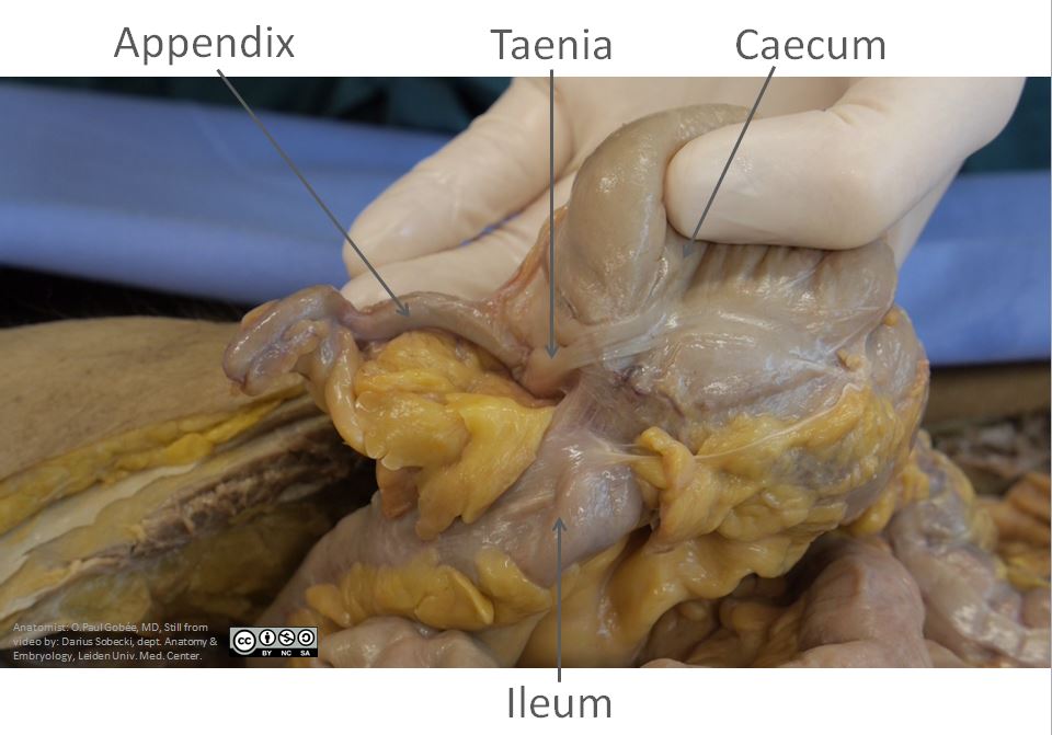 Dissection photo showing the begin of the taenia at the base of the appendix.