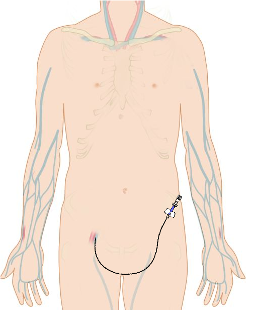 Intravenous catheter in (right) femoral vein