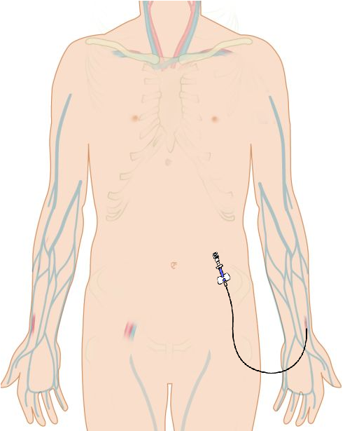 Catheter in (left) radial artery