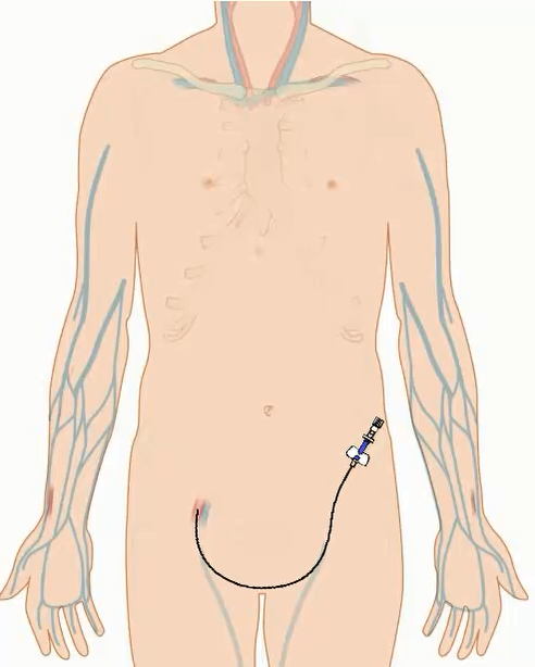Catheter in femoral artery