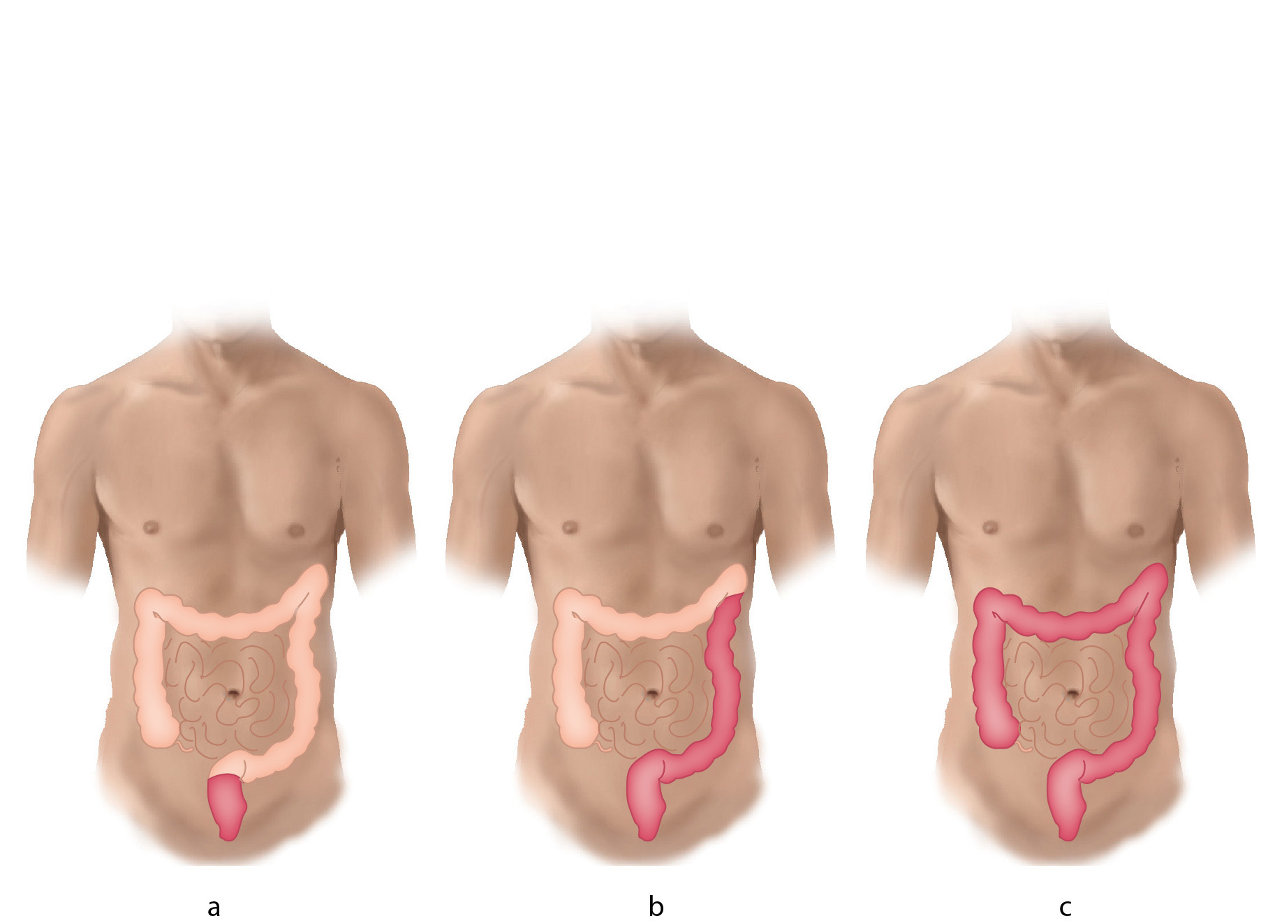 Three levels of extent of colitis 