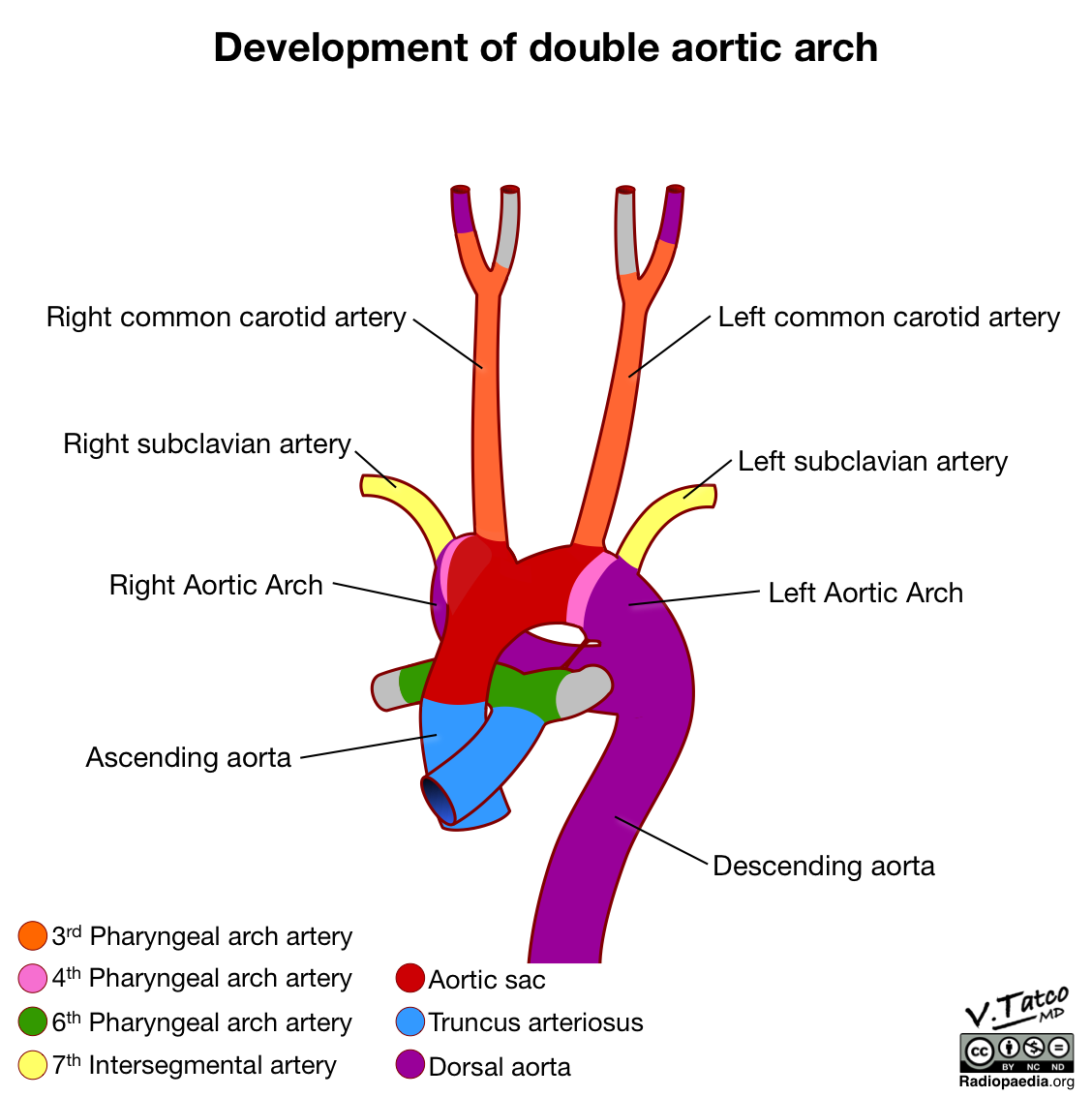 Radiopaedia - Drawing Development of double aortic arch - English ...