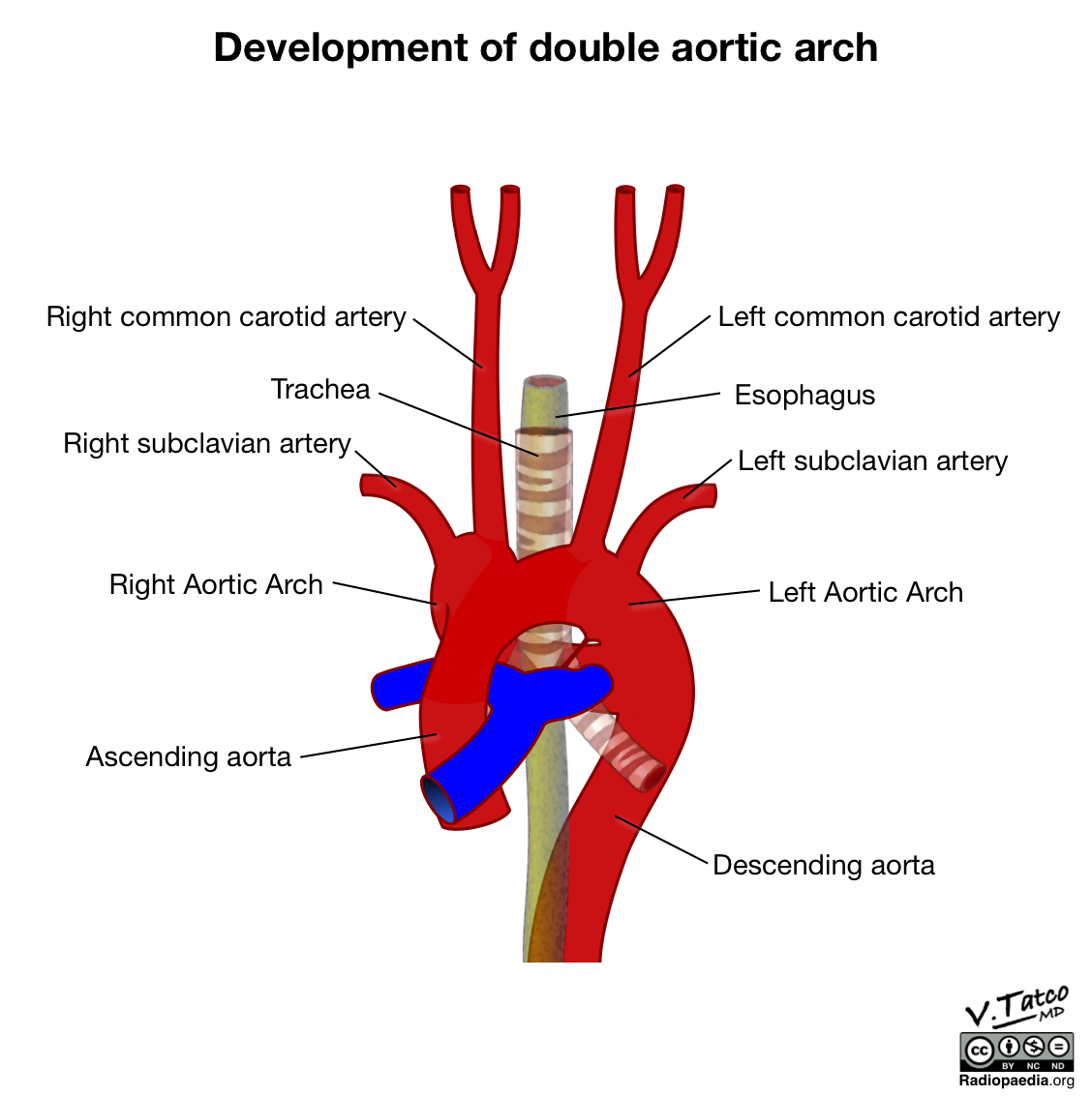 Radiopaedia Drawing Double Aortic Arch And Its Branches English