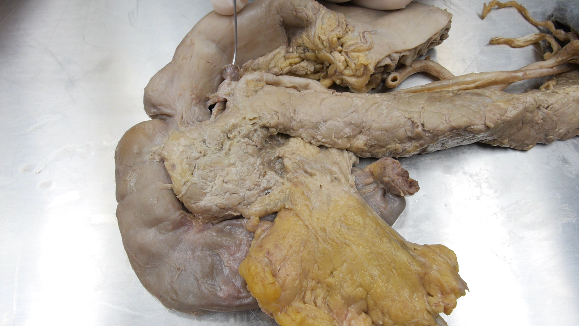 Duodenum and pancreas dissection specimen