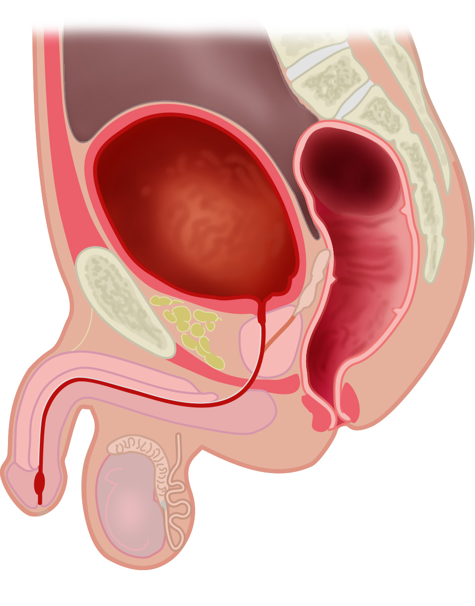 A filled bladder displaces the peritoneum upwards and brings the bladder preperitoneal