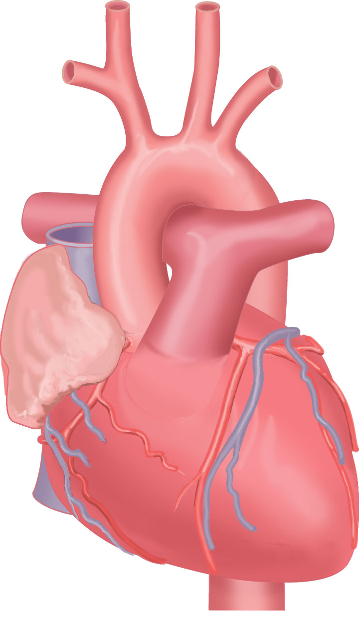 Heart with coronary arteries and veins (without left auricle)