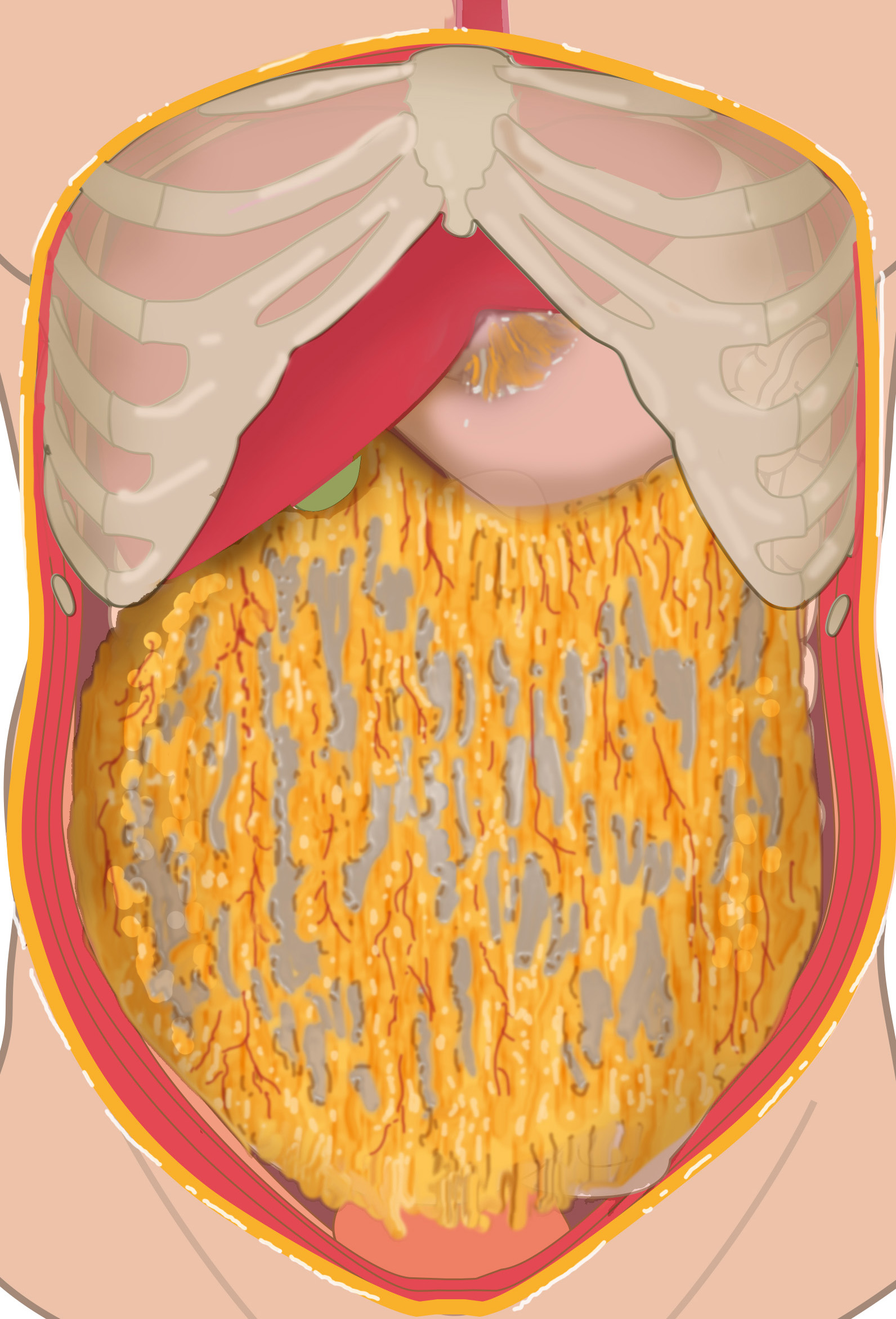 Opened peritoneal cavity