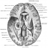 Sobotta 1909 fig.637 - Lateral and third ventricles of the brain, superior view - English labels