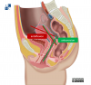 Leiden - Drawing Anteversion vs. Anteflexion of uterus - English labels