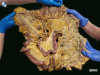 Leiden - Photo Colon, mesocolon, marginal artery (dissection) - no labels