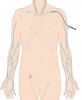 Catheter in (left) subclavian artery