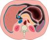 Peritoneal lining in transverse section abdomen (caudal view)