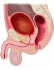 A filled bladder displaces the peritoneum upwards and brings the bladder preperitoneal