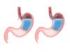 Gastro Esophageal Reflux Disease (GERD) 