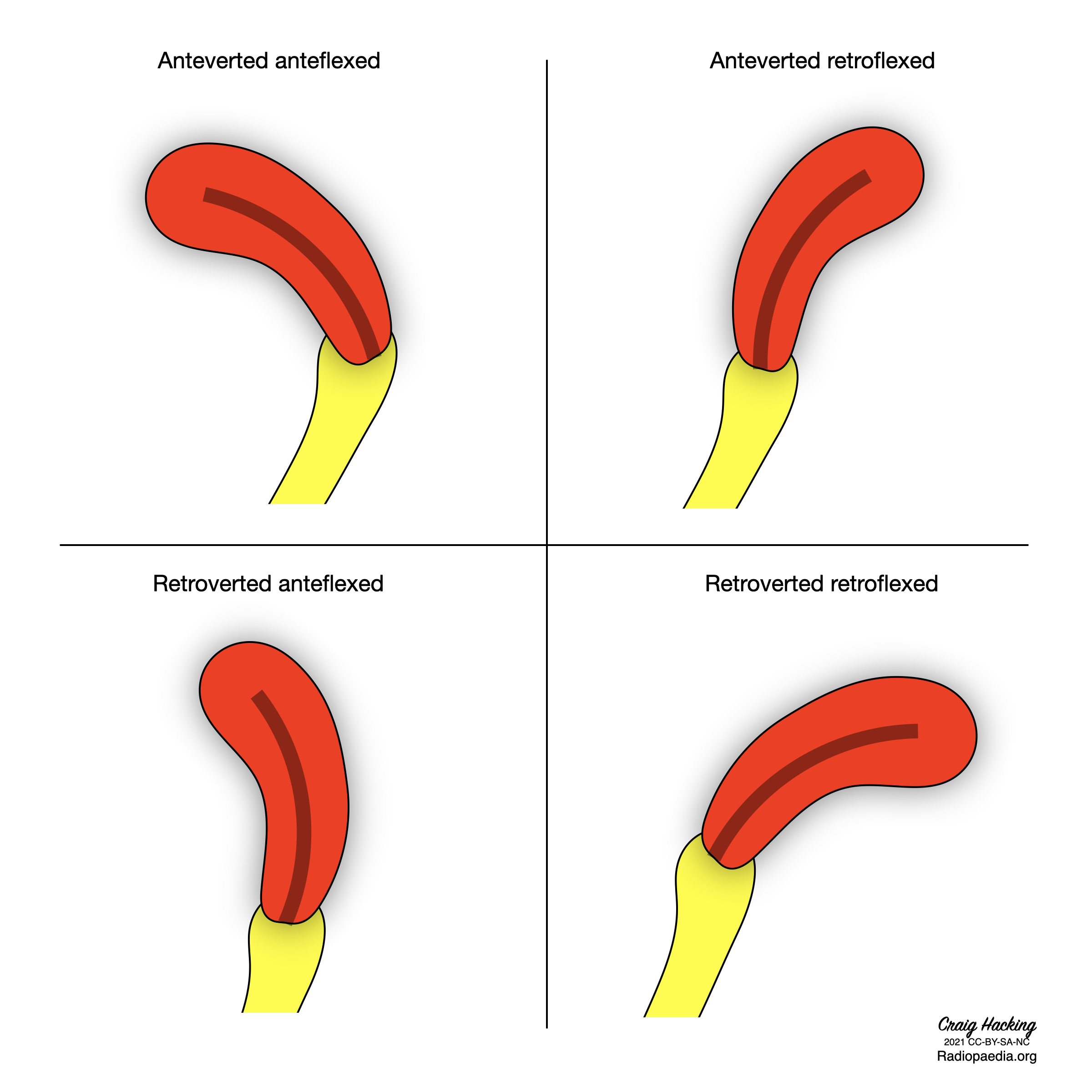 radiopaedia-drawing-positions-of-uterus-no-labels-anatomytool